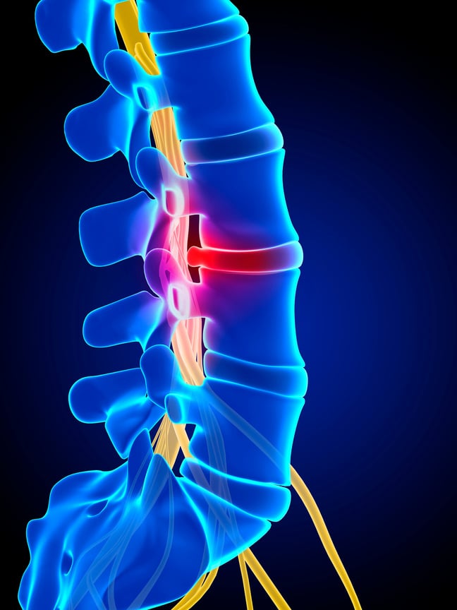 "Human spinal disc herniation (slipped disc)